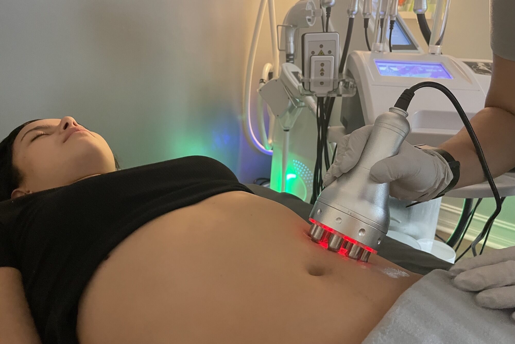 Radiofrequency skin tightening treatment at Esencia Med Spa in Davie FL
