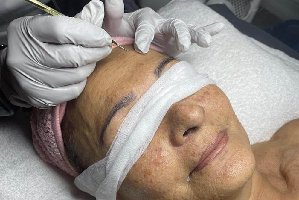 Acne Treatment