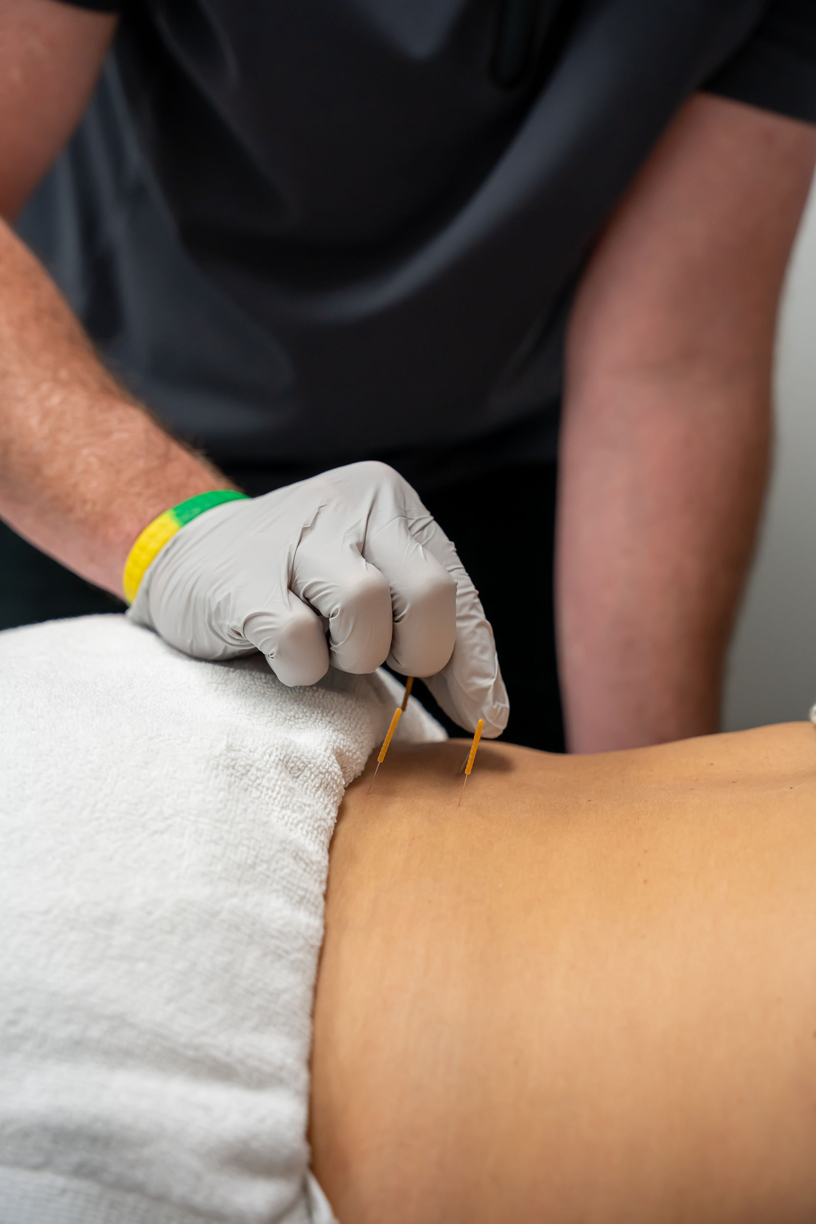 Dry needling therapy at Esencia in Davie FL